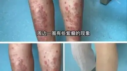 潍坊牛皮癣忌吃什么:潍坊银康牛皮癣医院—银屑病晚期症状和治疗