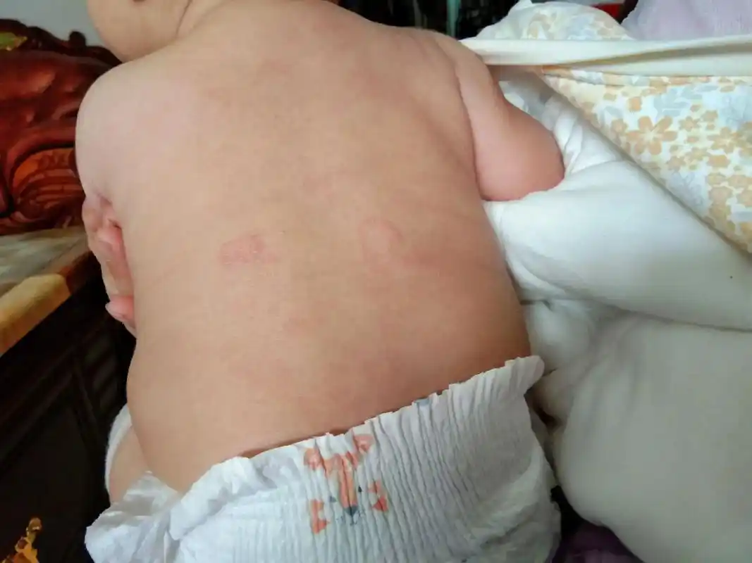 想问一下宝宝身上出这一片一片的到底是什么?