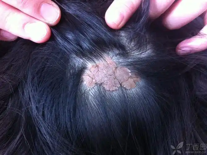 【病例讨论】6岁儿童头部肿物是什么? [病例帖]