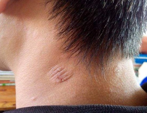 汗斑图片大全51