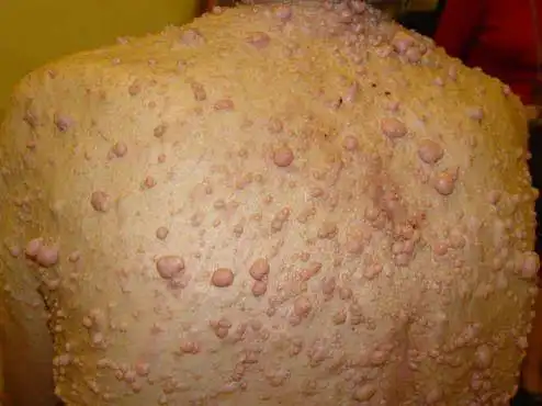 plos medicine|确定良性神经纤维瘤病1型肿瘤何时癌变