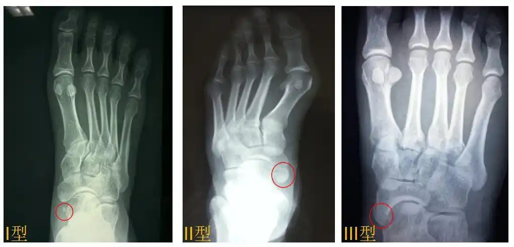 足的副舟骨是什么梗看完这篇文章就全明白了