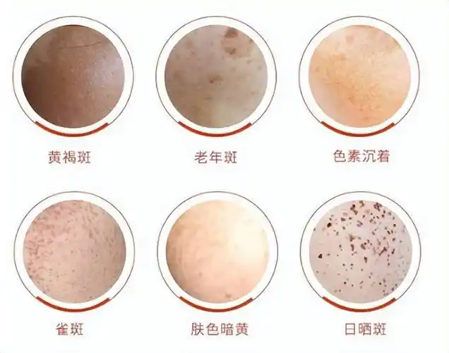 对付黄褐斑有新招!探秘外泌体——黄褐斑的新克星