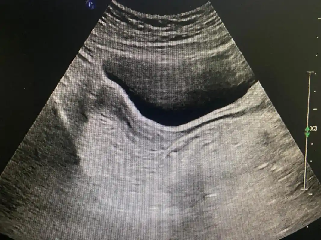 幼稚子宫吗.幼稚子宫#b超检查  在青春期前的任何时期,子宫 - 抖音