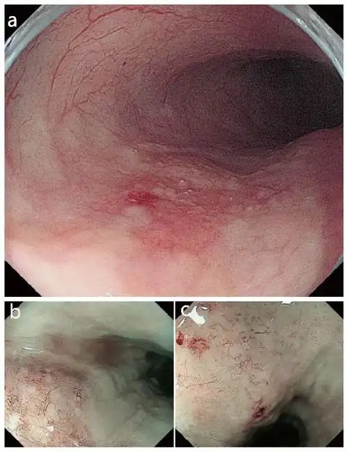 早期食管癌内镜错误评估病例