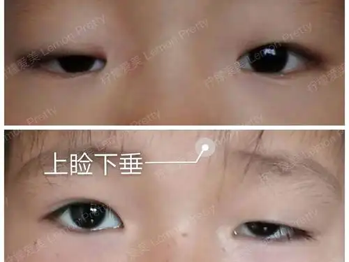 上睑下垂问题应该如何矫正?