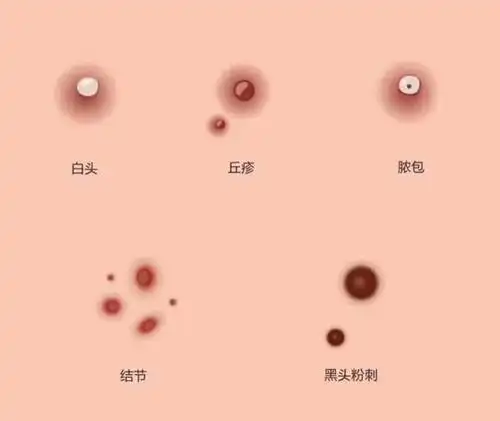 脸上长痘别急着"抠"!学会这样做,不留痘印还好的快!