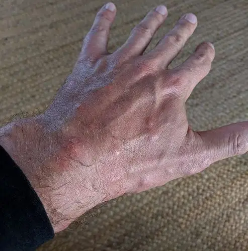 【其他情报】 坐长途机同床虱「困兽斗」 乘客困11个钟被咬150次