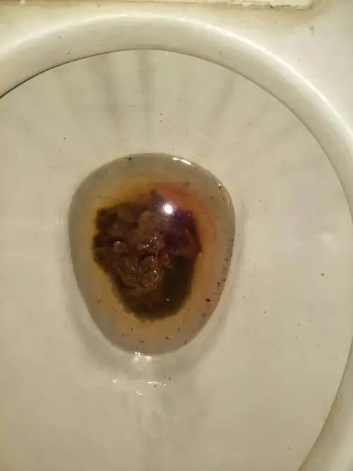 便后手纸带血,暗红,有血块状.