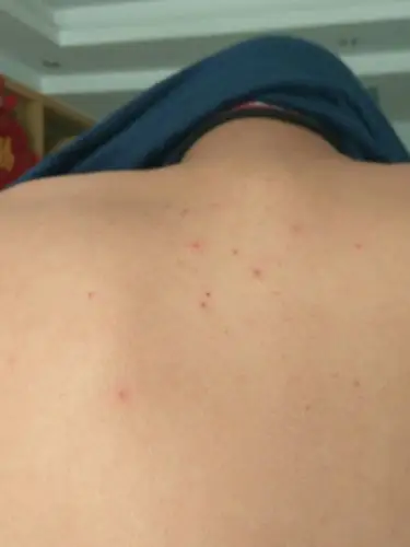 暂未定制 其他回答 青春痘,只不过有人是长在脸上,而你却长在后背