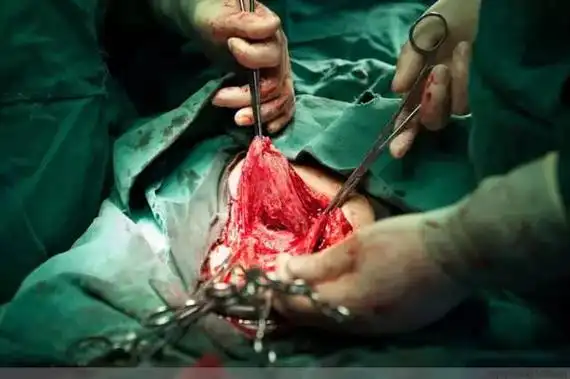 100张剖腹产过程照片女人真的太伟大了