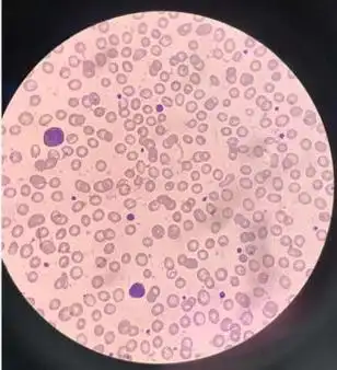 巨/大血小板导致的血小板计数假性减少如何处理?