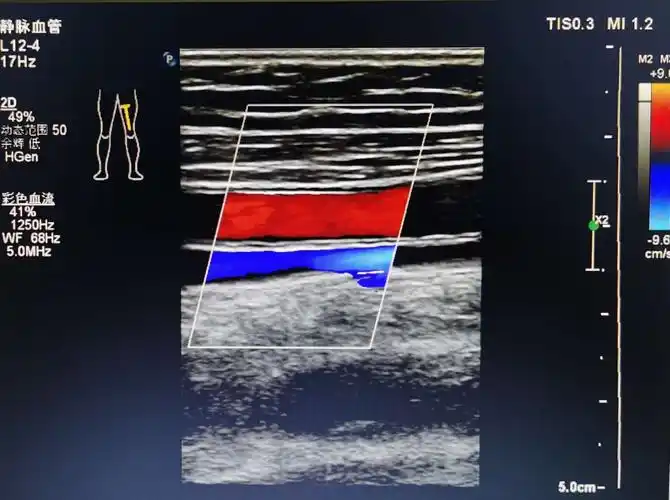 下肢静脉血栓形成 - 超声医学讨论版 - 爱爱医医学论坛