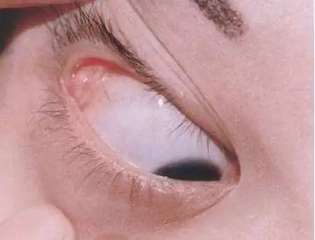 眼科 泪腺脱垂临床表现及治疗 泪腺脱垂较罕见,常为双侧,多发病25岁