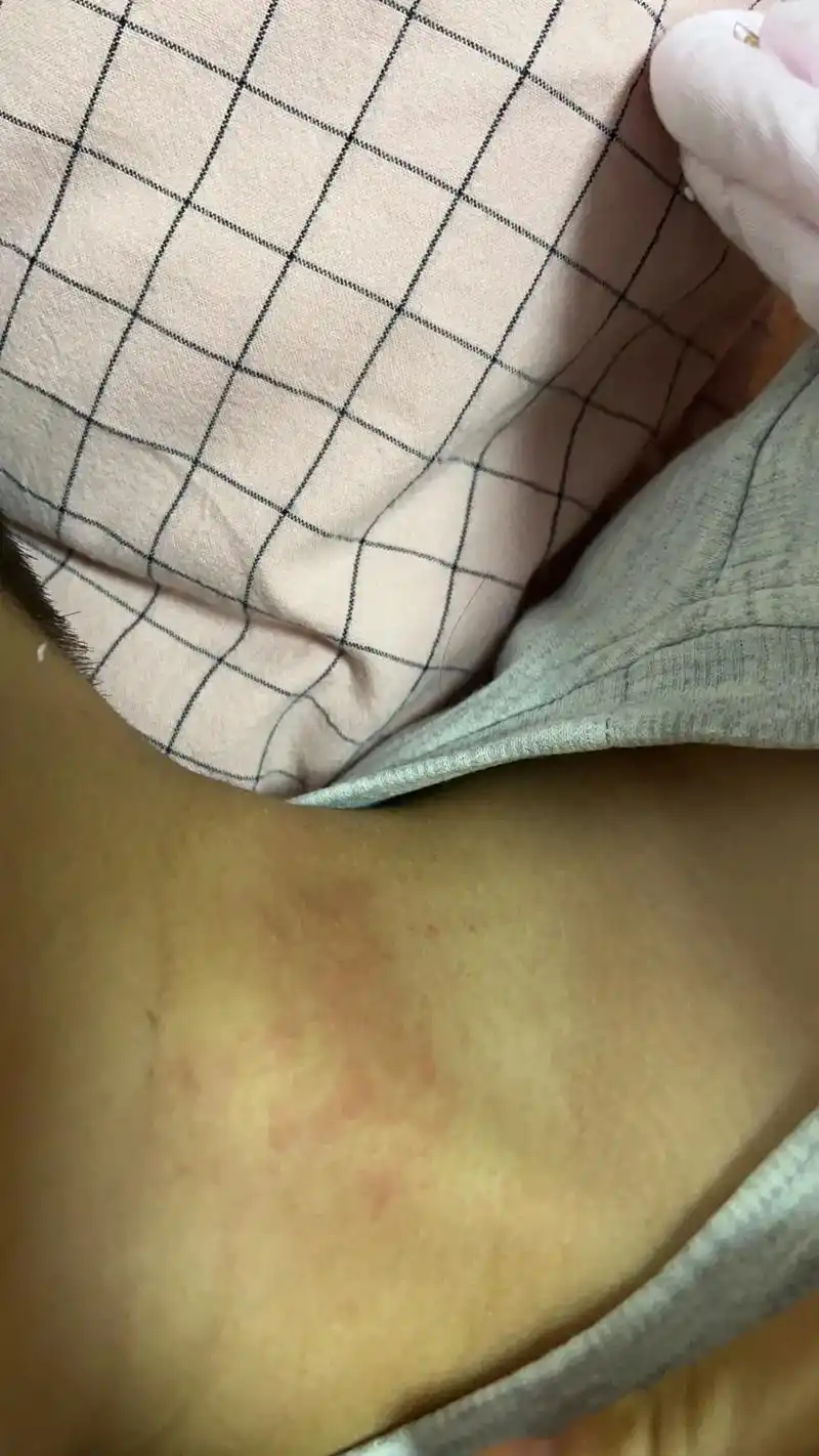 甲流退烧以后身上起红疹.