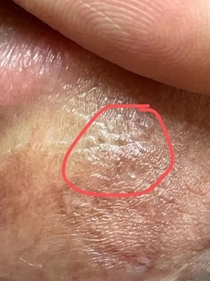 尖锐湿疣并做了激光,后来用药后一直没有复发,2021年10月做过hpv阴性