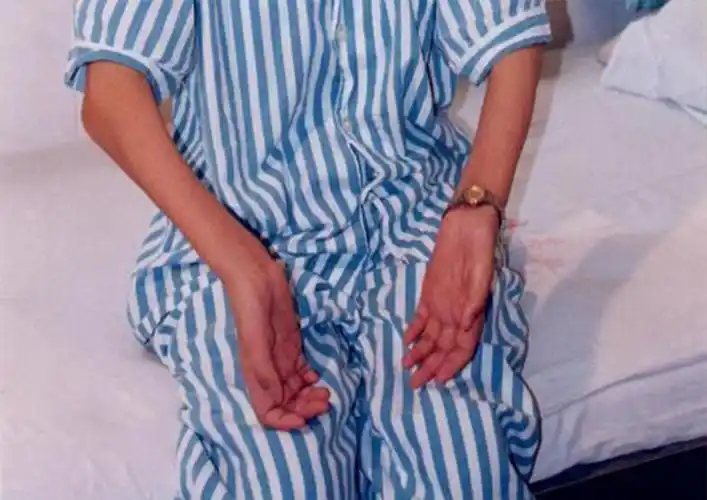 重症肌无力受累肌肉的分布特点