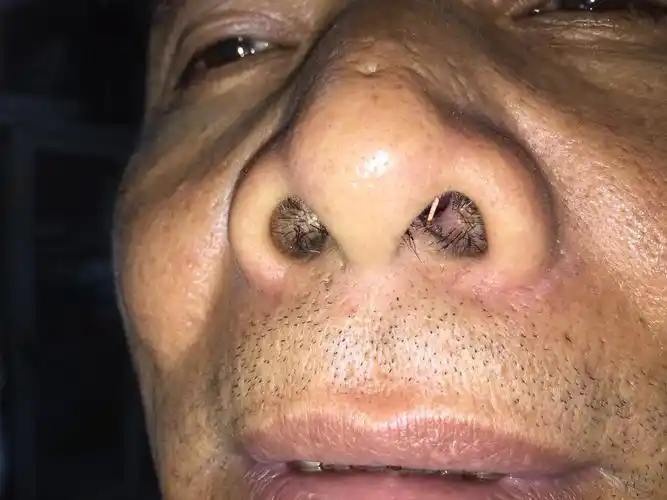 鼻窦炎流脓困扰原来是这样