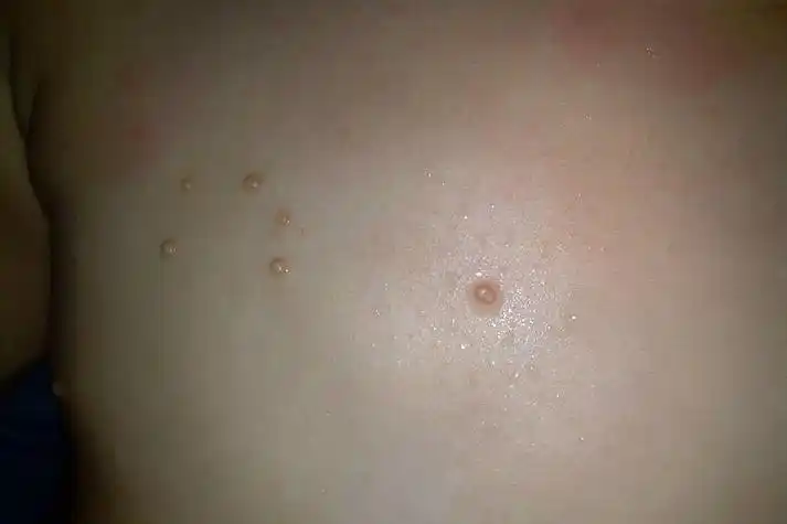 肚子传染性软疣图