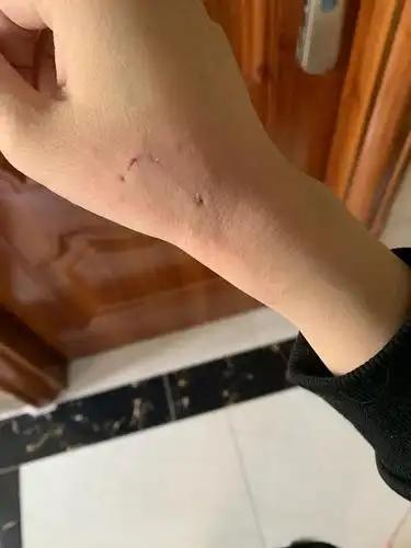 被自家猫咪咬出血要不要打针