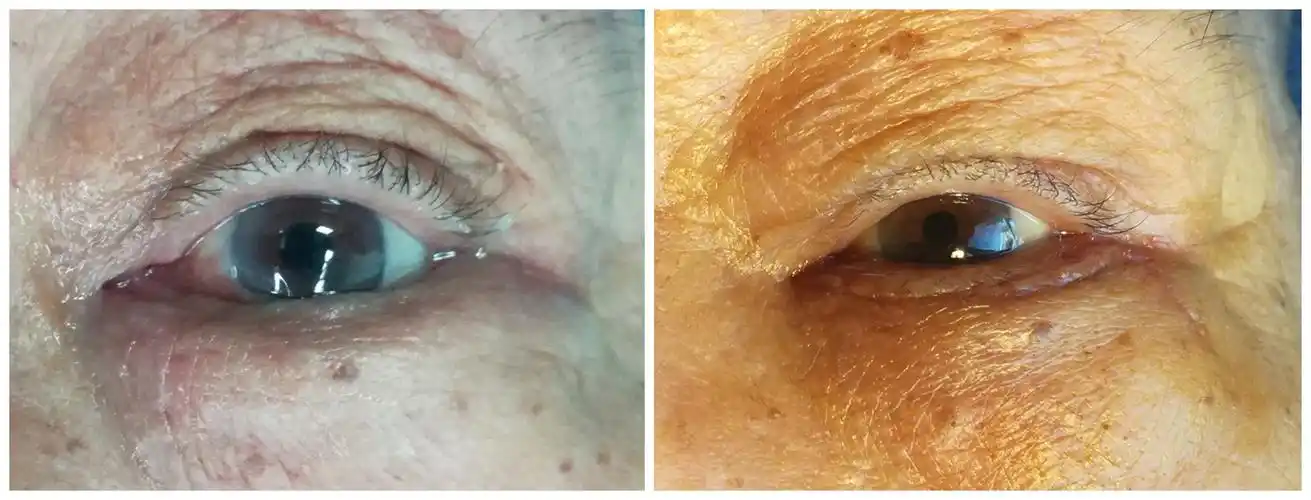 老年性眼睑内翻手术