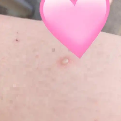 请问这个腿上的白痘痘是什么呀慎入