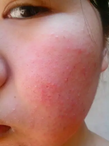 螨虫过敏症状图片