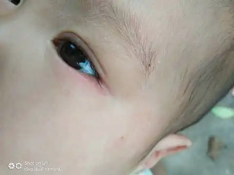 我家宝贝眼角会红怎么回事