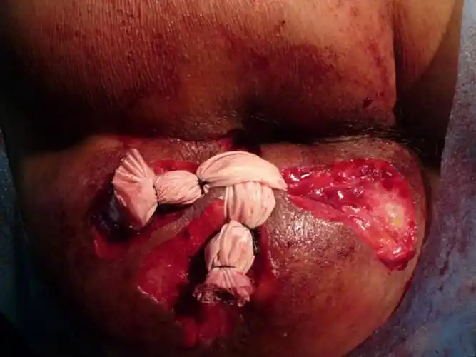 不处理内口做肛瘘手术图片_有来医生