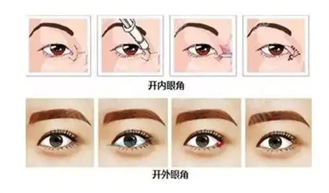 开内外眼角的区别