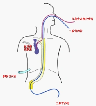 学习强国浙江最多浙江大学邵逸夫医院周建仓团队治愈60多例食道瘘重症