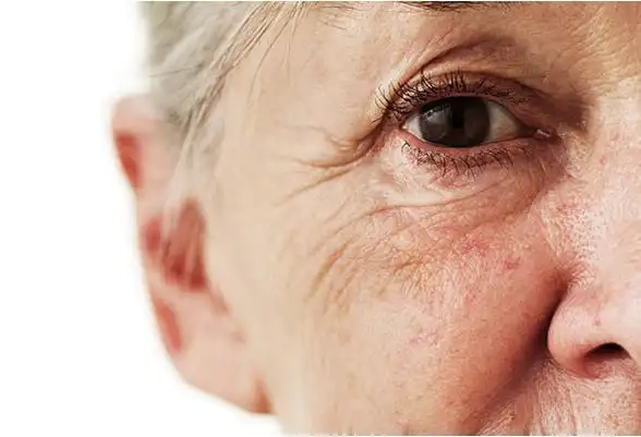 皱纹可以说是最直观的面部变化表现之一,抬头纹,鱼尾纹,川字纹,眼部