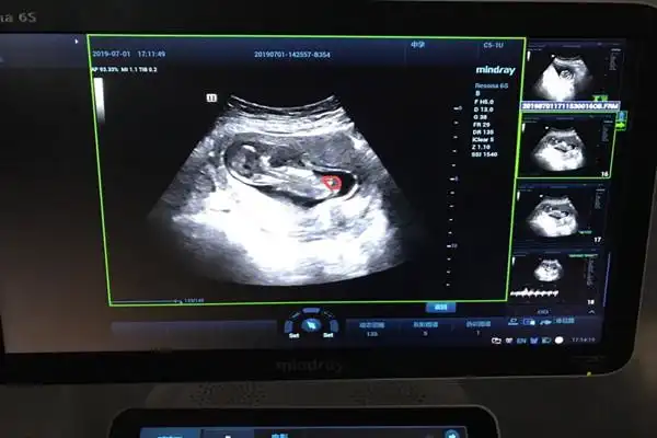 nt单子男孩有圈圈 妈妈说这是怀男孩的特征