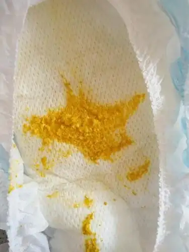 宝宝大便一天56次蛋花汤一样是拉肚子吗