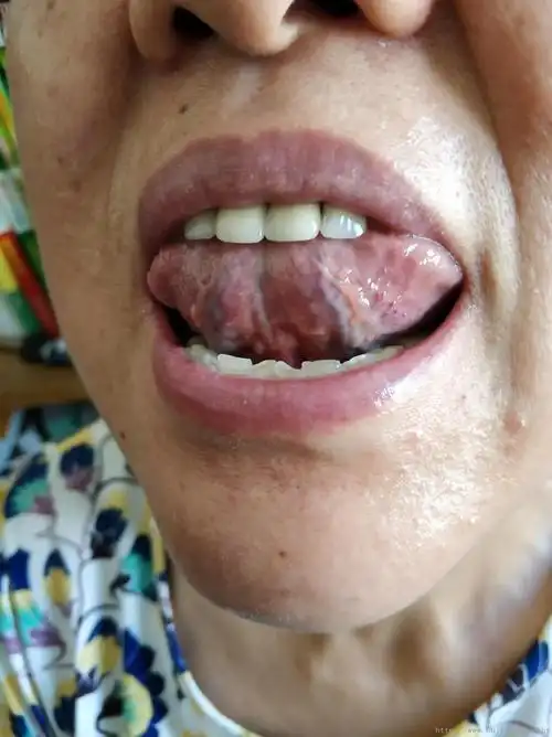 柴胡加龙骨牡蛎汤合栀子厚朴汤治疗诸多愁诉