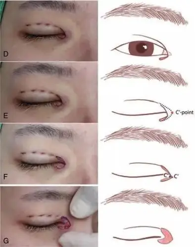 韩国新术式:"回旋镖式"内眦赘皮矫正术