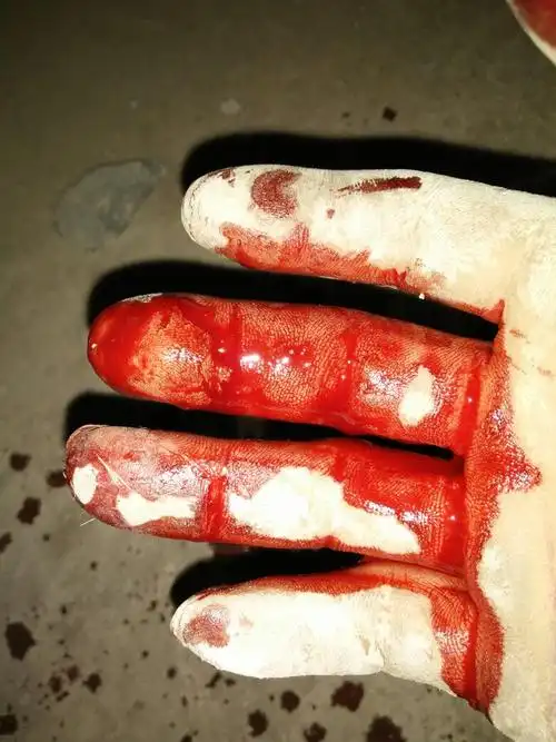 我手昨天在工地上受伤,缝了7针.