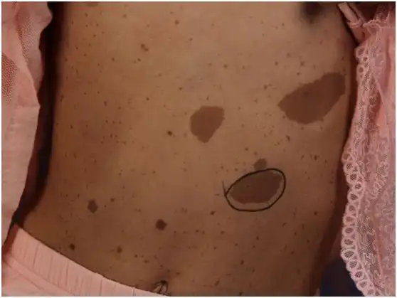 郑州市第二中医院科普咖啡斑的临床表现有哪些