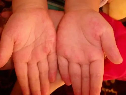 孩子的手掌有些地方,红色斑,特别是指尖和手边,口腔和脚没有疱疹,请问