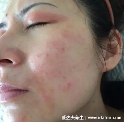 系统性红斑狼疮图片皮肤图片,脸部蝶形红斑日晒后严重