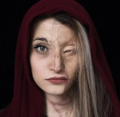 3名女大学生被泼硫酸毁容有人说那是她们活该