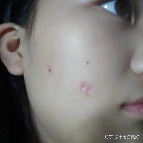 点痣后有坑 - 知乎