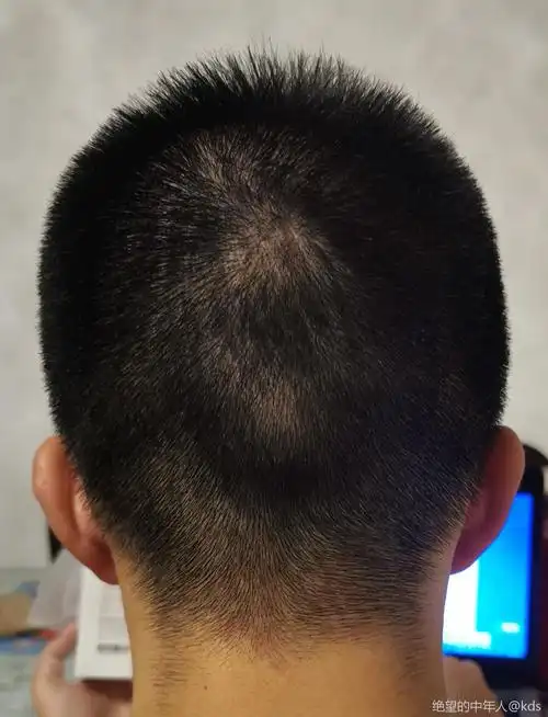 头发越来越少了