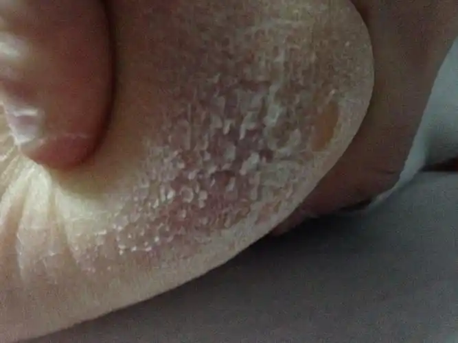 脚底下脱皮这是什么原因呢