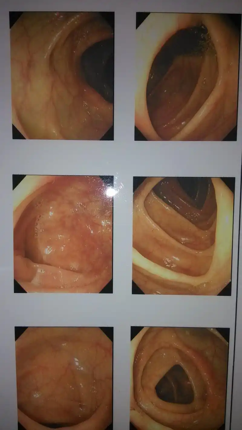 无痛肠镜可以报医保吗 肠镜医保吗