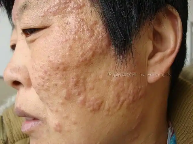 面部丘疹结节伴痒21年