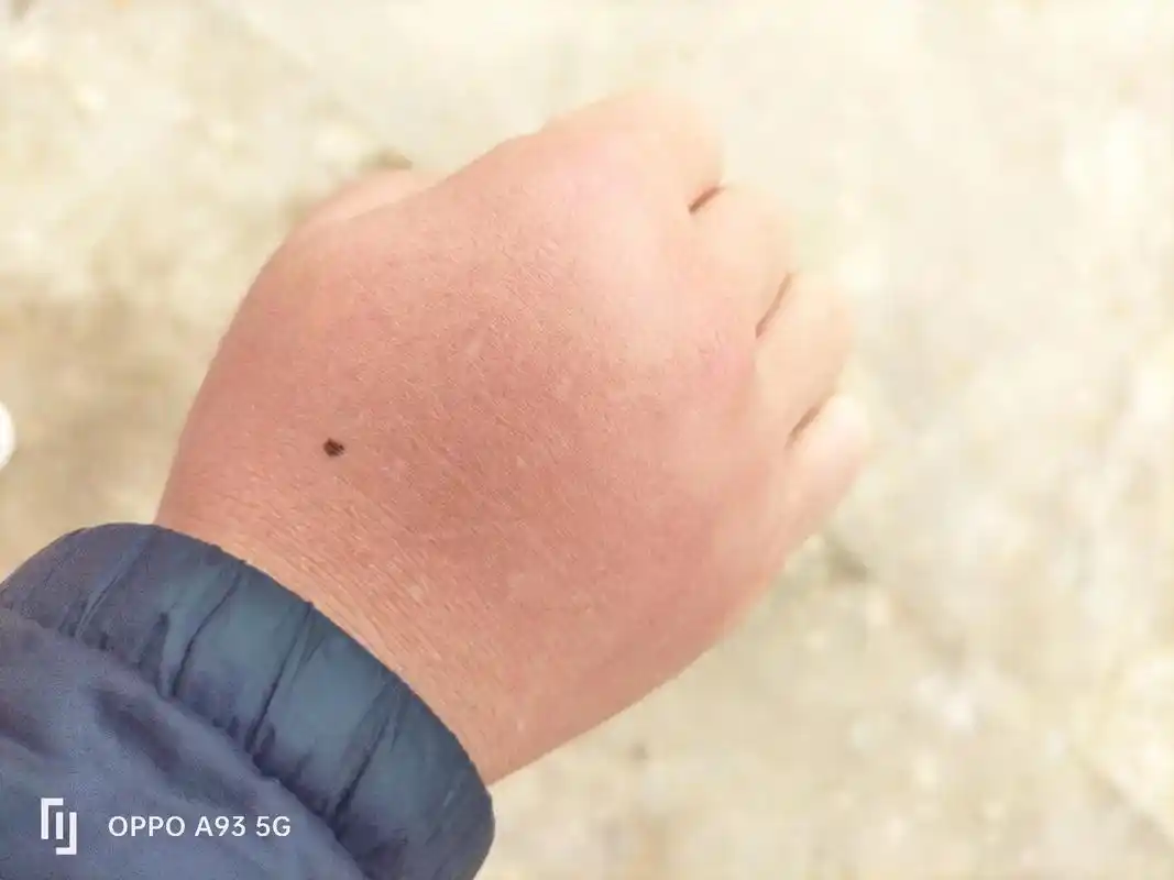 红蚂蚁,可能指的是红火蚁,咬人的毒性,通常比较大.被红火蚁咬 - 抖音