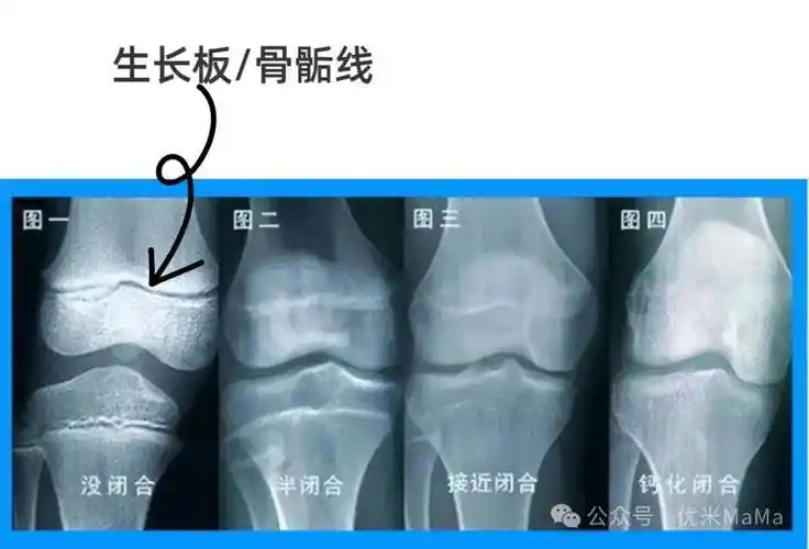 大部分关注孩子身高的家长,应该都知道"生长板",它位于长骨的两端,是
