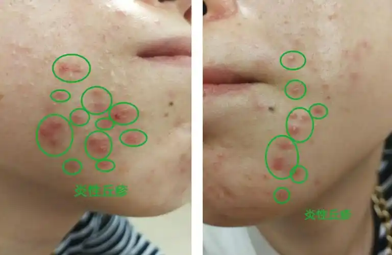 炎性丘疹和脓疱:当痤疮杆菌(当然还有其它的葡萄球菌,链球菌,甚至糠秕