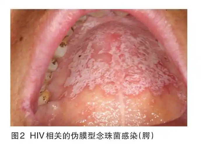 aids患者和hiv携带者很多存在口腔病损你能发现它们么